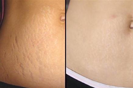 Home Remedies To Remove Stretch Marks Naturally