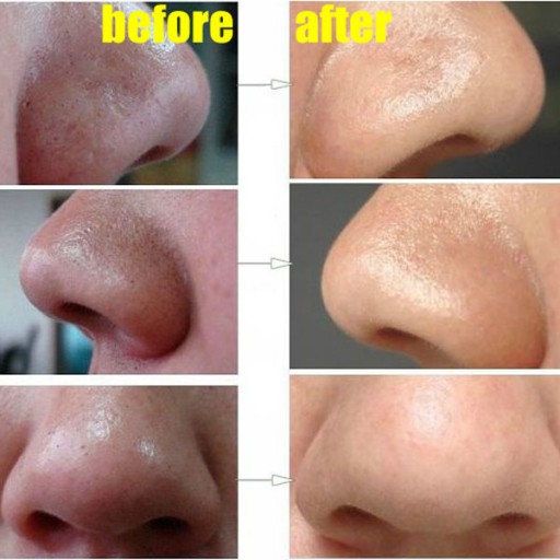 How To Easily Remove Deep Blackheads On Your Nose
