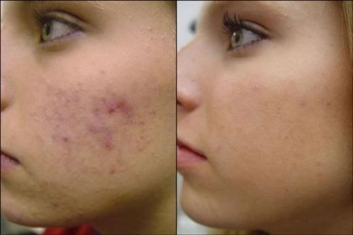 How To Get Rid Of Acne