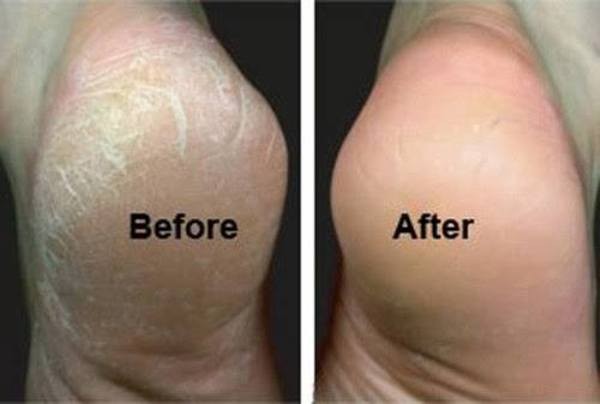 How To Treat Cracked Feet